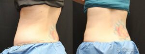 Coolsculpting Before and After Photos - Patient 21B