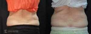Coolsculpting Before and After Photos - Patient 22A