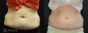 Coolsculpting Before and After Photos - Patient 22B