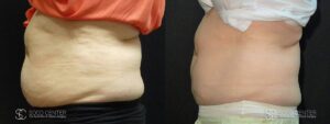 Coolsculpting Before and After Photos - Patient 22C