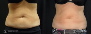 Coolsculpting Before and After Photos - Patient 23A