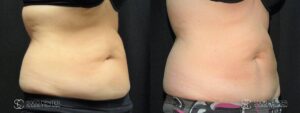 Coolsculpting Before and After Photos - Patient 23C