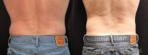 Coolsculpting Before and After Photos - Patient 24A