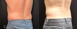 Coolsculpting Before and After Photos - Patient 24B
