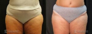 Coolsculpting Before and After Photos - Patient 25A