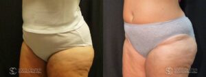 Coolsculpting Before and After Photos - Patient 25B