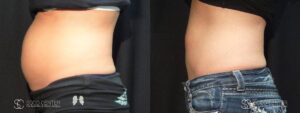 Coolsculpting Before and After Photos - Patient 26A