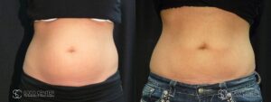 Coolsculpting Before and After Photos - Patient 26B