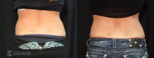 Coolsculpting Before and After Photos - Patient 26C