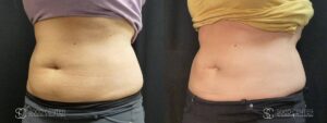 Coolsculpting Before and After Photos - Patient 27A