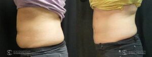 Coolsculpting Before and After Photos - Patient 27B