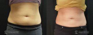 Coolsculpting Before and After Photos - Patient 27C