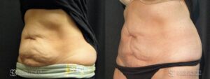 Coolsculpting Before and After Photos - Patient 28A