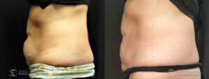 Coolsculpting Before and After Photos - Patient 28B