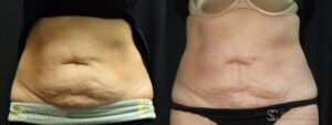 Coolsculpting Before and After Photos - Patient 28C