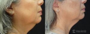 Coolsculpting Before and After Photos - Patient 29B