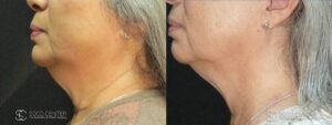 Coolsculpting Before and After Photos - Patient 29C
