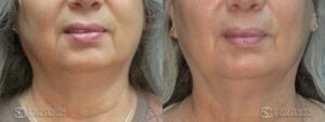 Coolsculpting Before and After Photos - Patient 29A