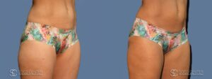 Coolsculpting Before and After Photos - Patient 2A