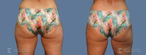 Coolsculpting Before and After Photos - Patient 2B