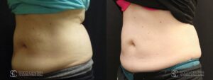 Coolsculpting Before and After Photos - Patient 6B