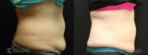 Coolsculpting Before and After Photos - Patient 6C
