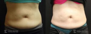 Coolsculpting Before and After Photos - Patient 6A