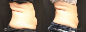 Coolsculpting Before and After Photos - Patient 8A