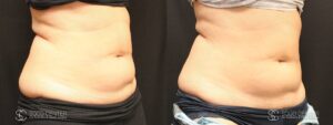 Coolsculpting Before and After Photos - Patient 8B