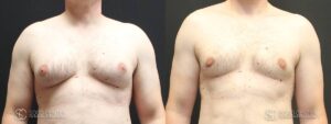 Gynecomastia Before and After Photo - Patient 2A
