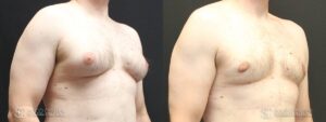 Gynecomastia Before and After Photo - Patient 2B