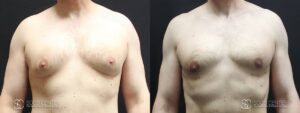 Gynecomastia Before and After Photo - Patient 3A
