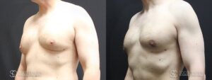 Gynecomastia Before and After Photo - Patient 3B