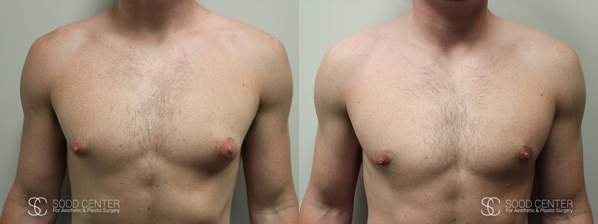 Gynecomastia Before and After Photo - Patient 1A
