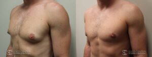 Gynecomastia Before and After Photo - Patient 1B