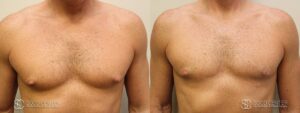 Gynecomastia Before and After Photo - Patient 4A