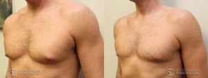Gynecomastia Before and After Photo - Patient 4B