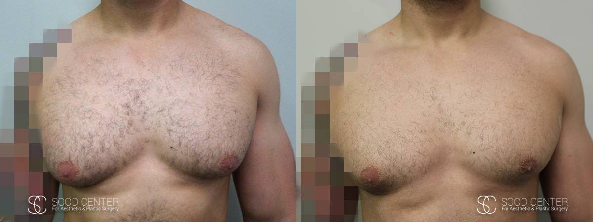 Gynecomastia Before and After Photo - Patient 5A