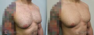 Gynecomastia Before and After Photo - Patient 5B
