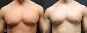 Gynecomastia Before and After Photo - Patient 6A