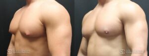 Gynecomastia Before and After Photo - Patient 6B