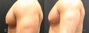Gynecomastia Before and After Photo - Patient 6C
