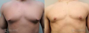 Gynecomastia Before and After Photo - Patient 7A