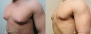 Gynecomastia Before and After Photo - Patient 7B