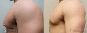 Gynecomastia Before and After Photo - Patient 7C