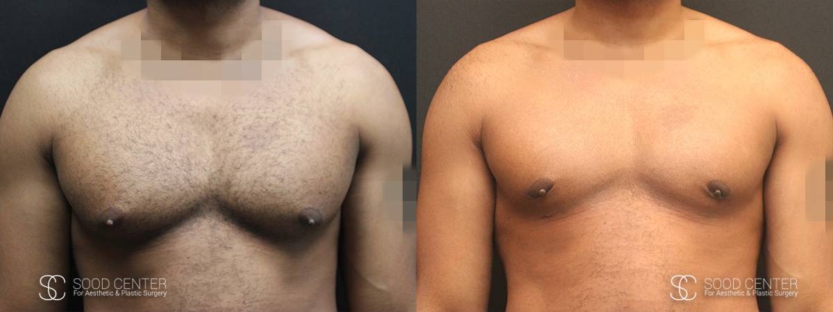 Gynecomastia Before and After Photo - Patient 8A