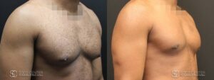 Gynecomastia Before and After Photo - Patient 8B