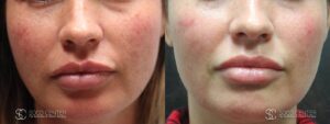 IPL Treatment Before and After Photo - Patient 4A
