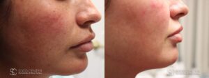 IPL Treatment Before and After Photo - Patient 4B