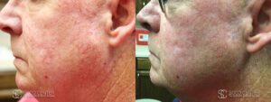 IPL Treatment Before and After Photo - Patient 5A